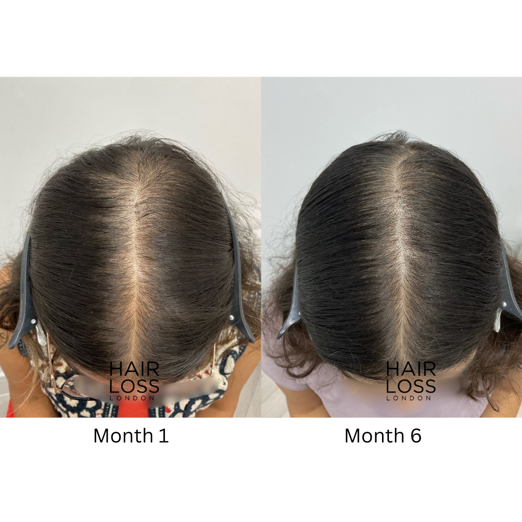 Hair loss London fulham