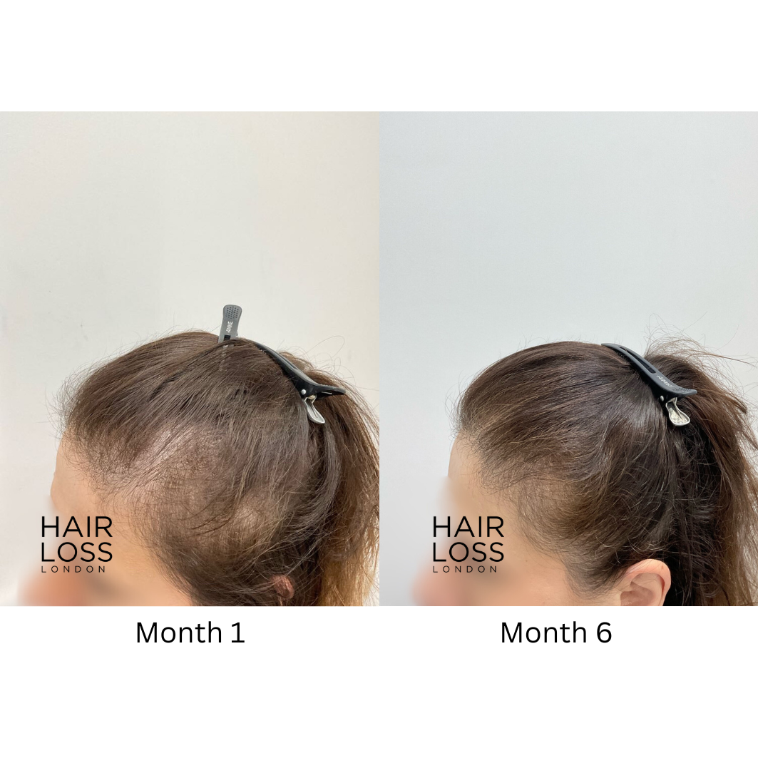 hair loss london Chelsea