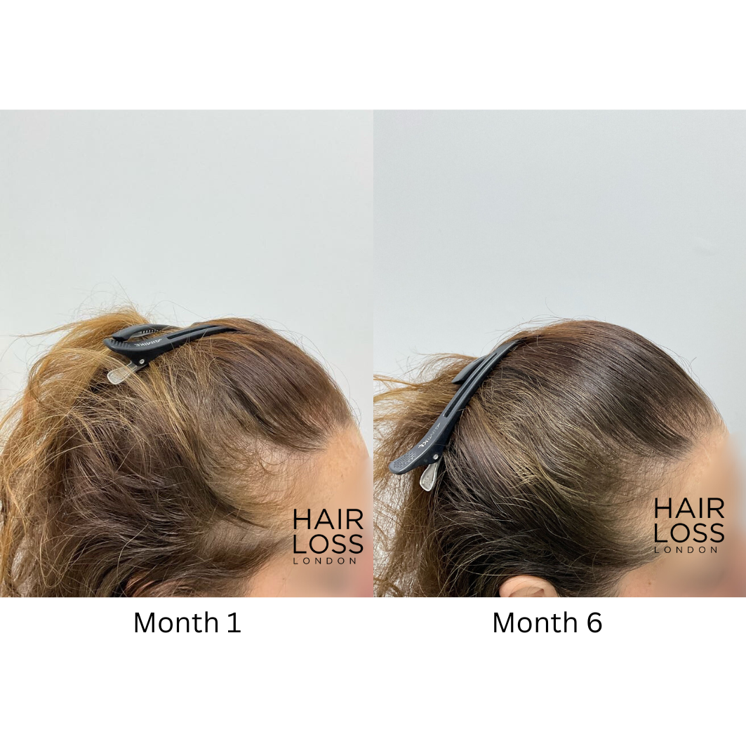 Hair loss since moving to London