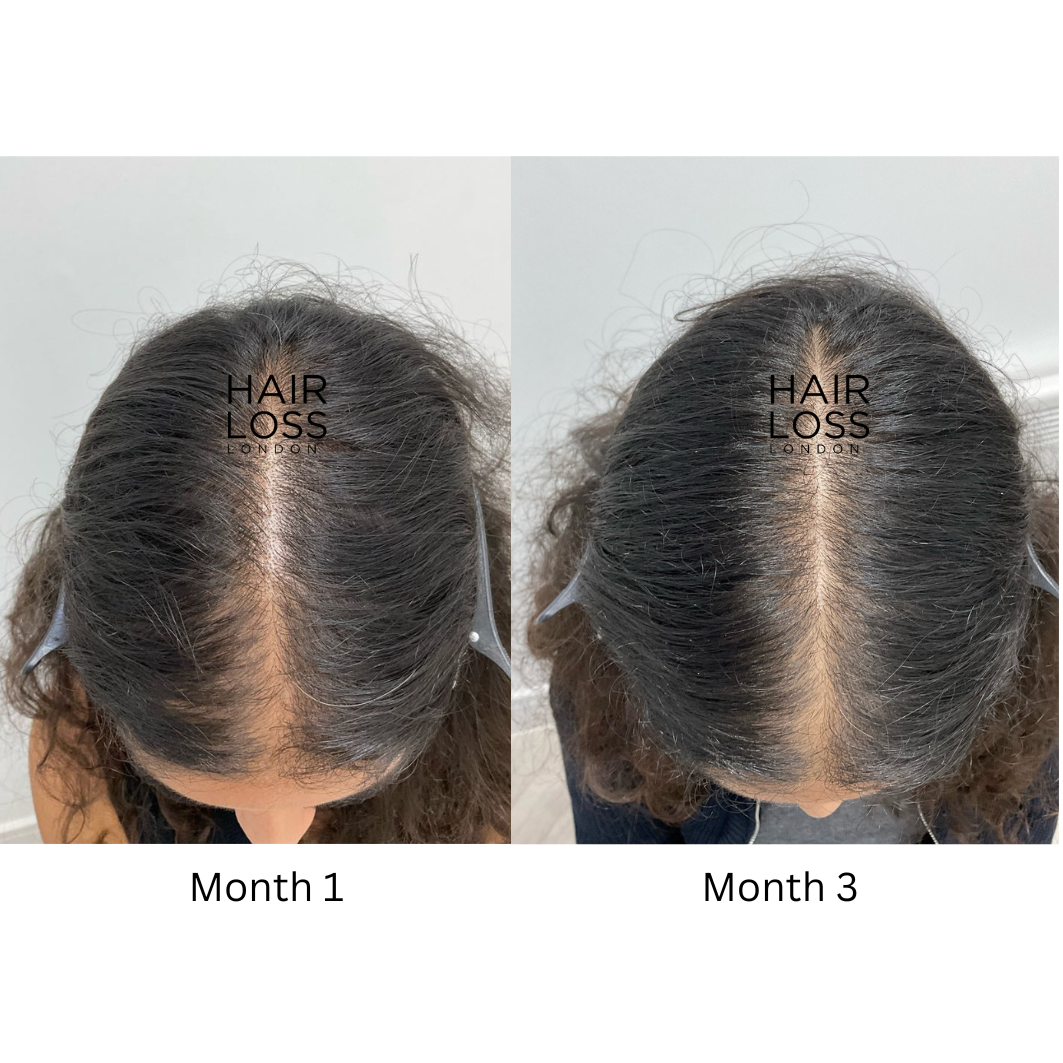 hair loss london Chelsea