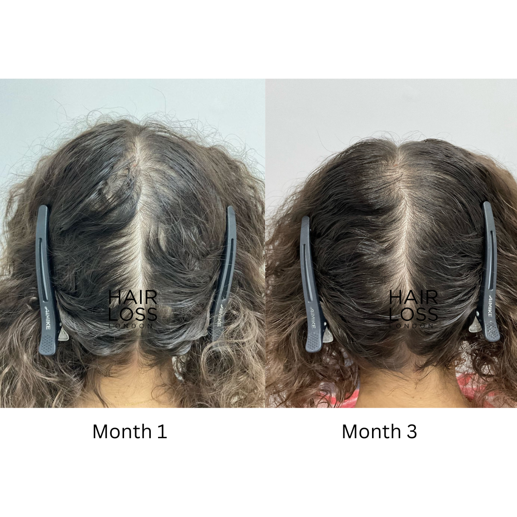 Hair loss since moving to London