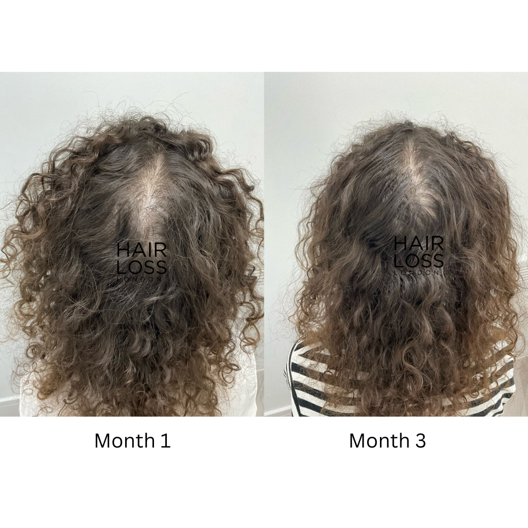 Hair loss since moving to London