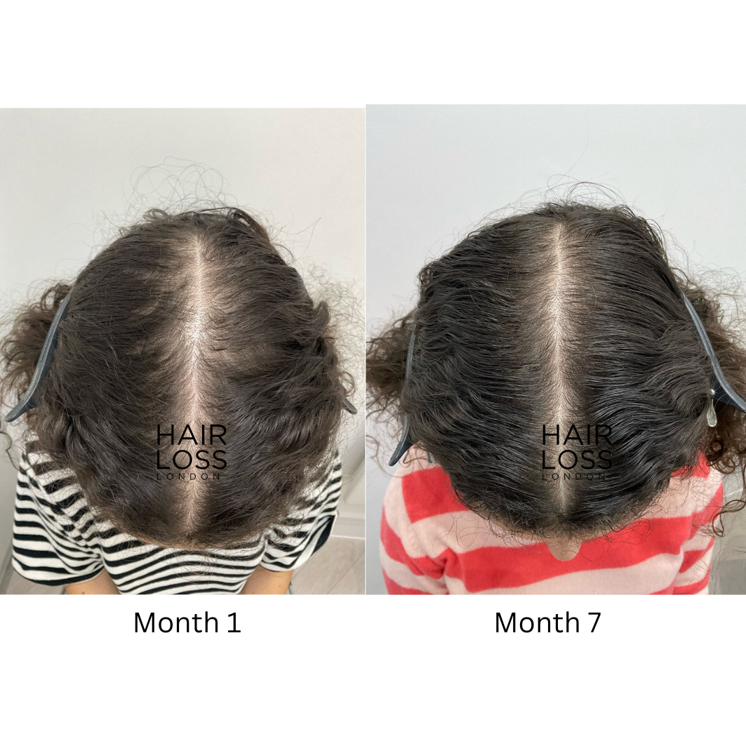 Hair loss london uliana