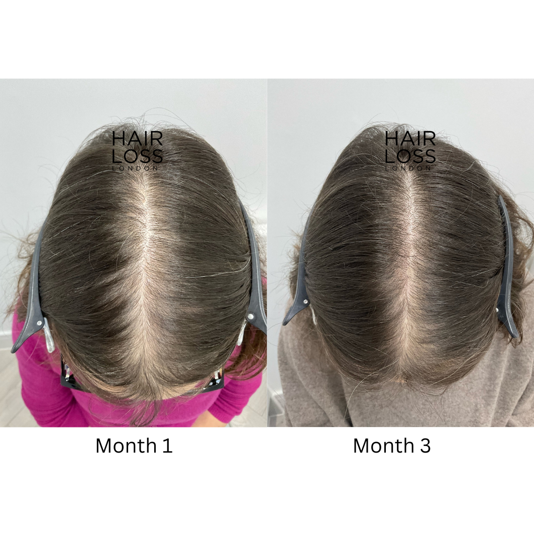 Hair loss London Chelsea