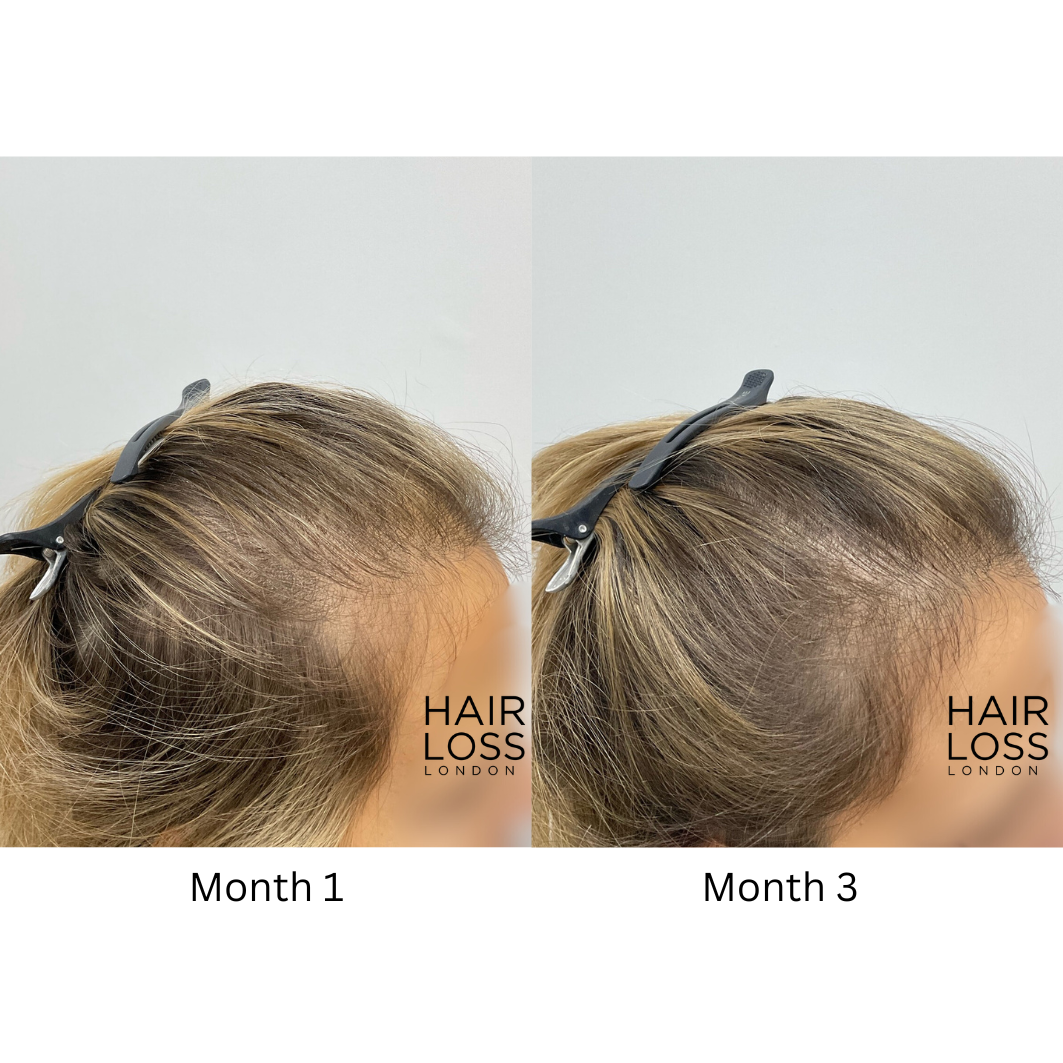 Hair loss London Chelsea
