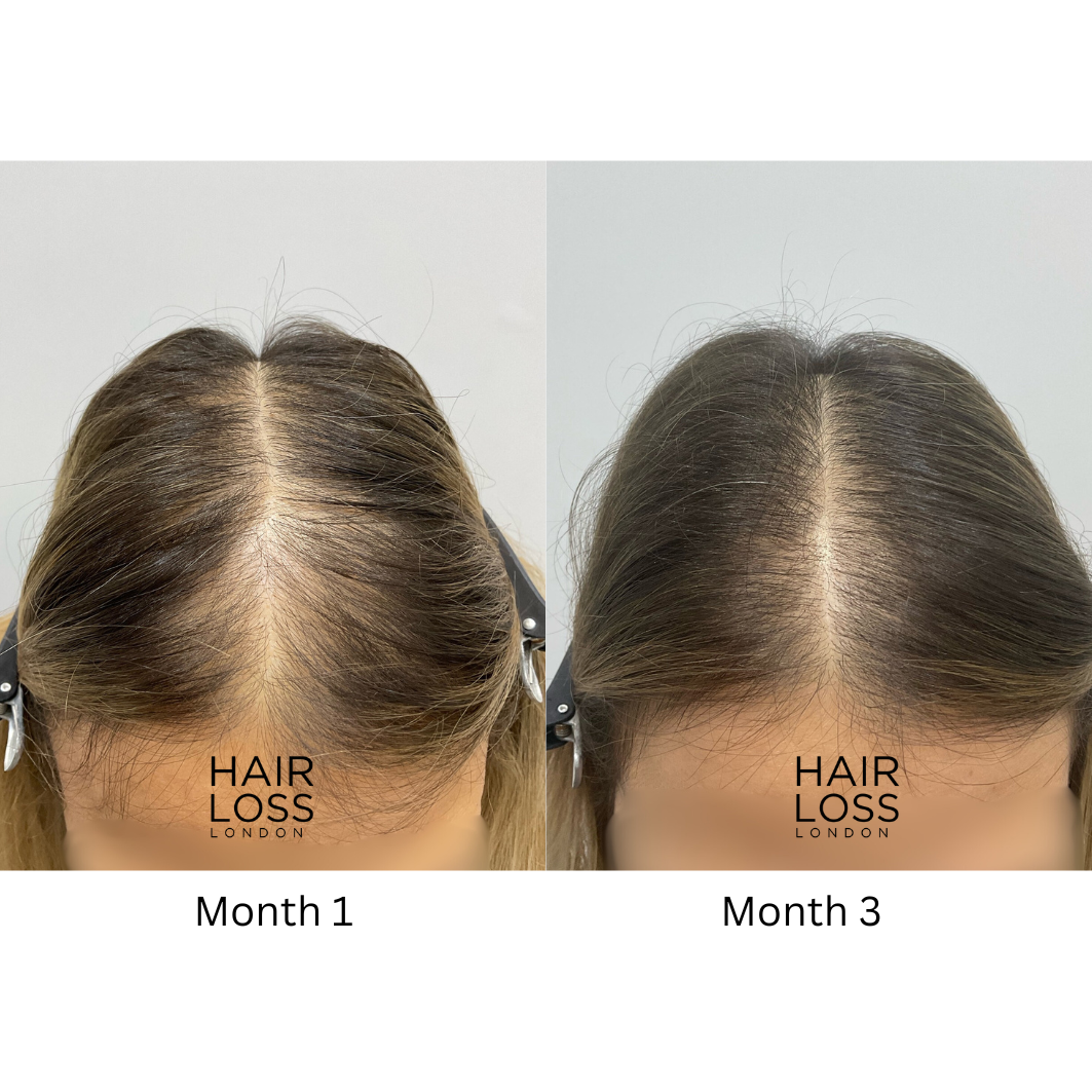 hair loss specialist London