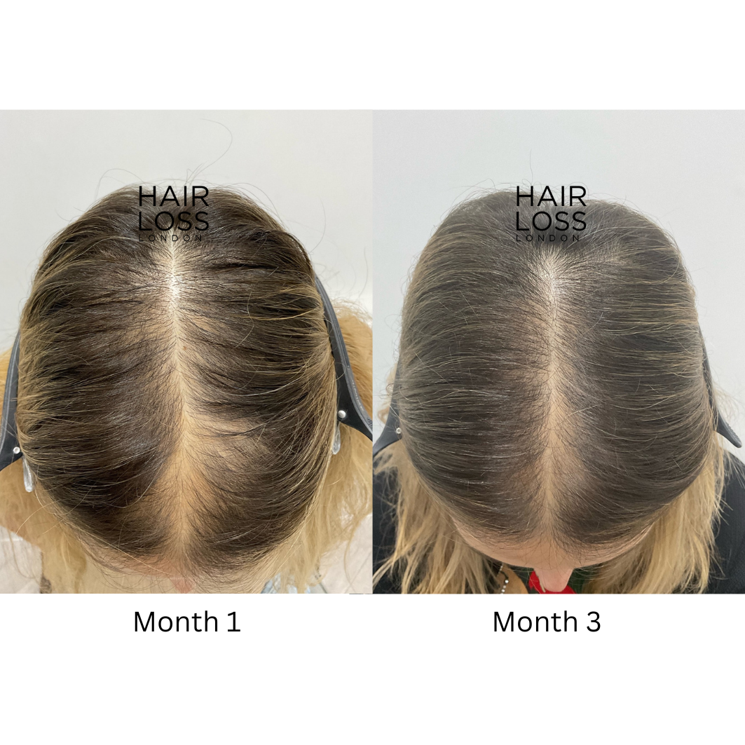 Female hair loss specialist London