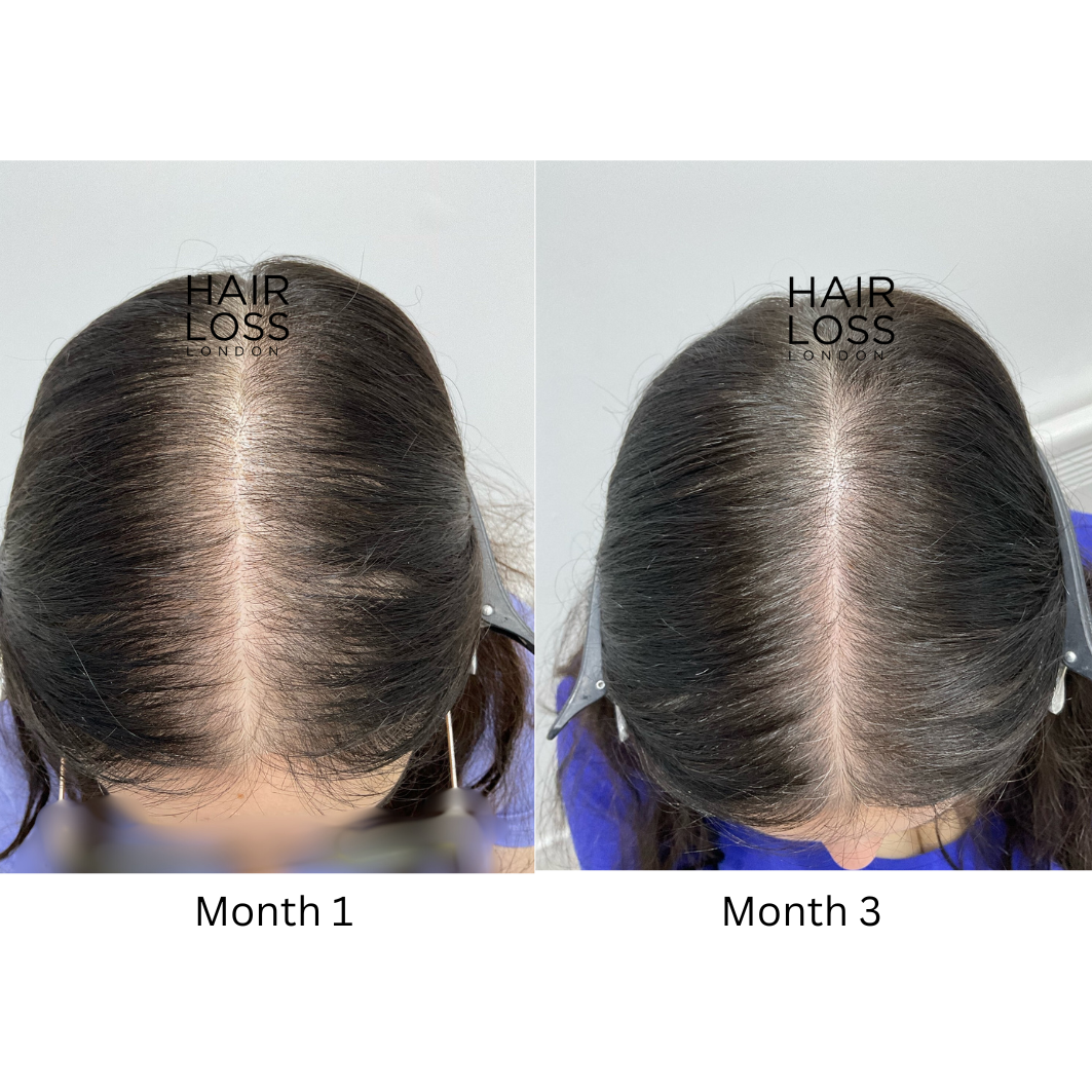Best hair loss Clinic London