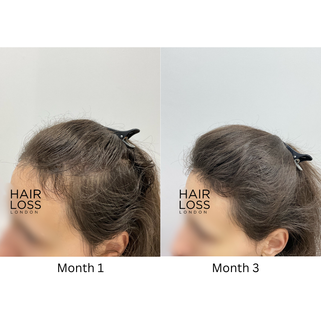 Female hair loss specialist London