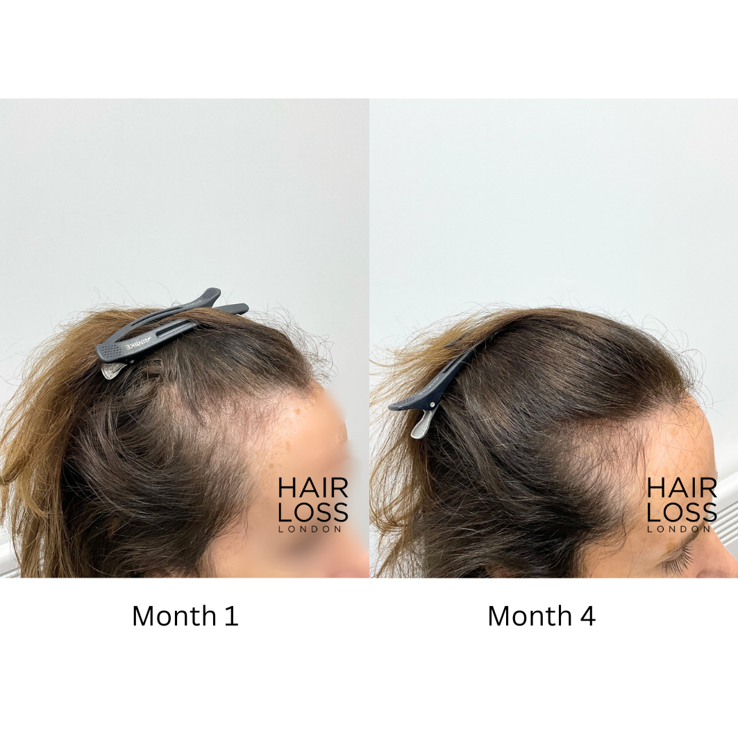 Hair loss London Chelsea