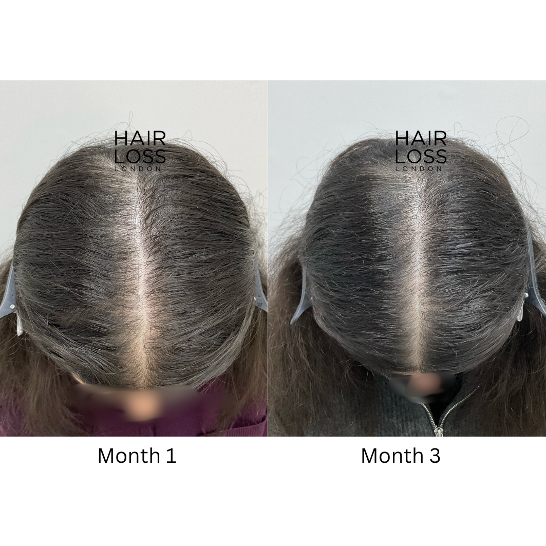 Female hair loss specialist London
