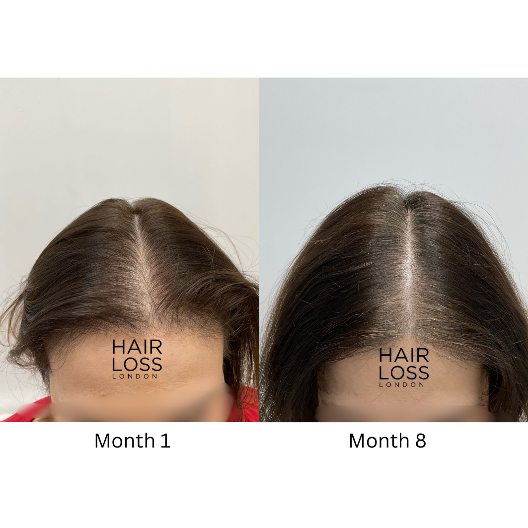 Best hair loss Clinic London
