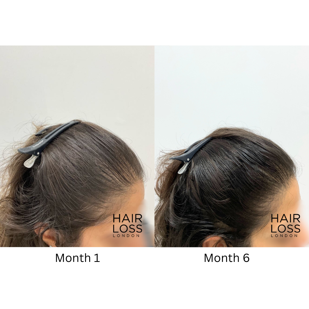 Female hair loss specialist London