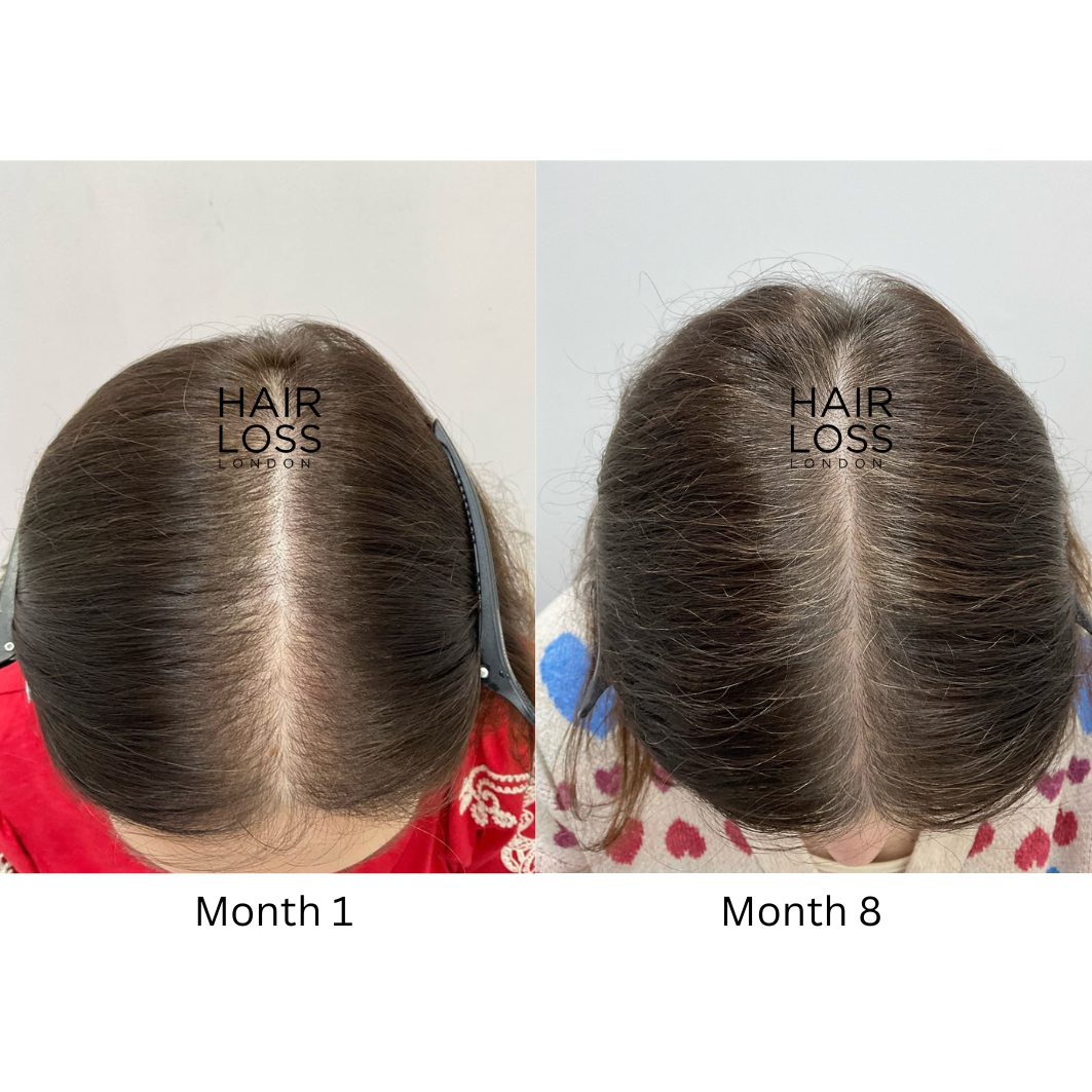 Female hair loss specialist London