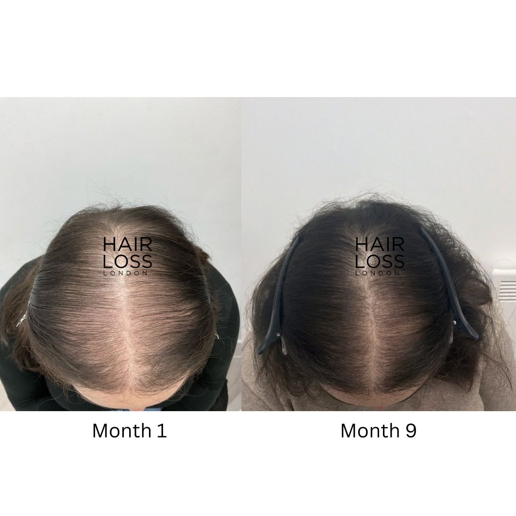 Female hair loss treatment London