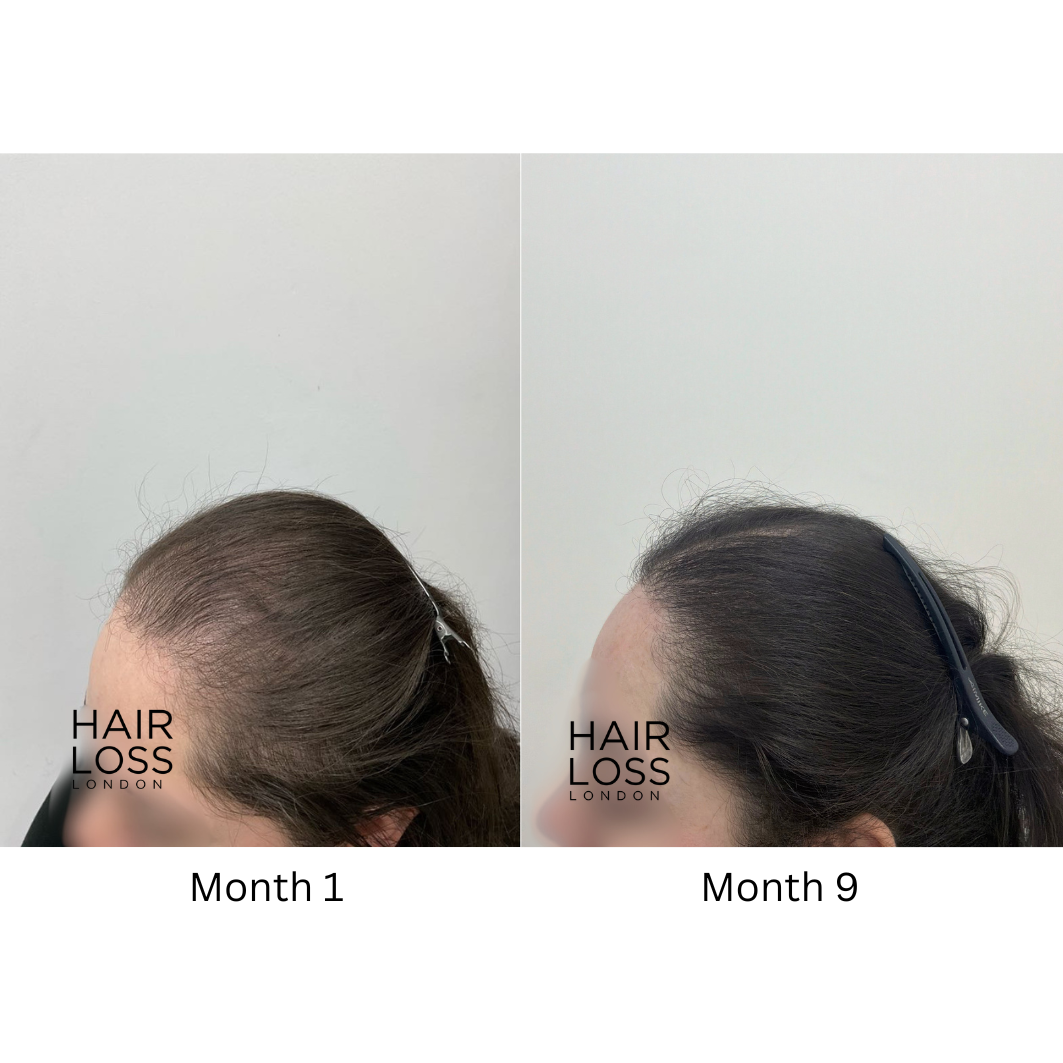 Female pattern hair loss