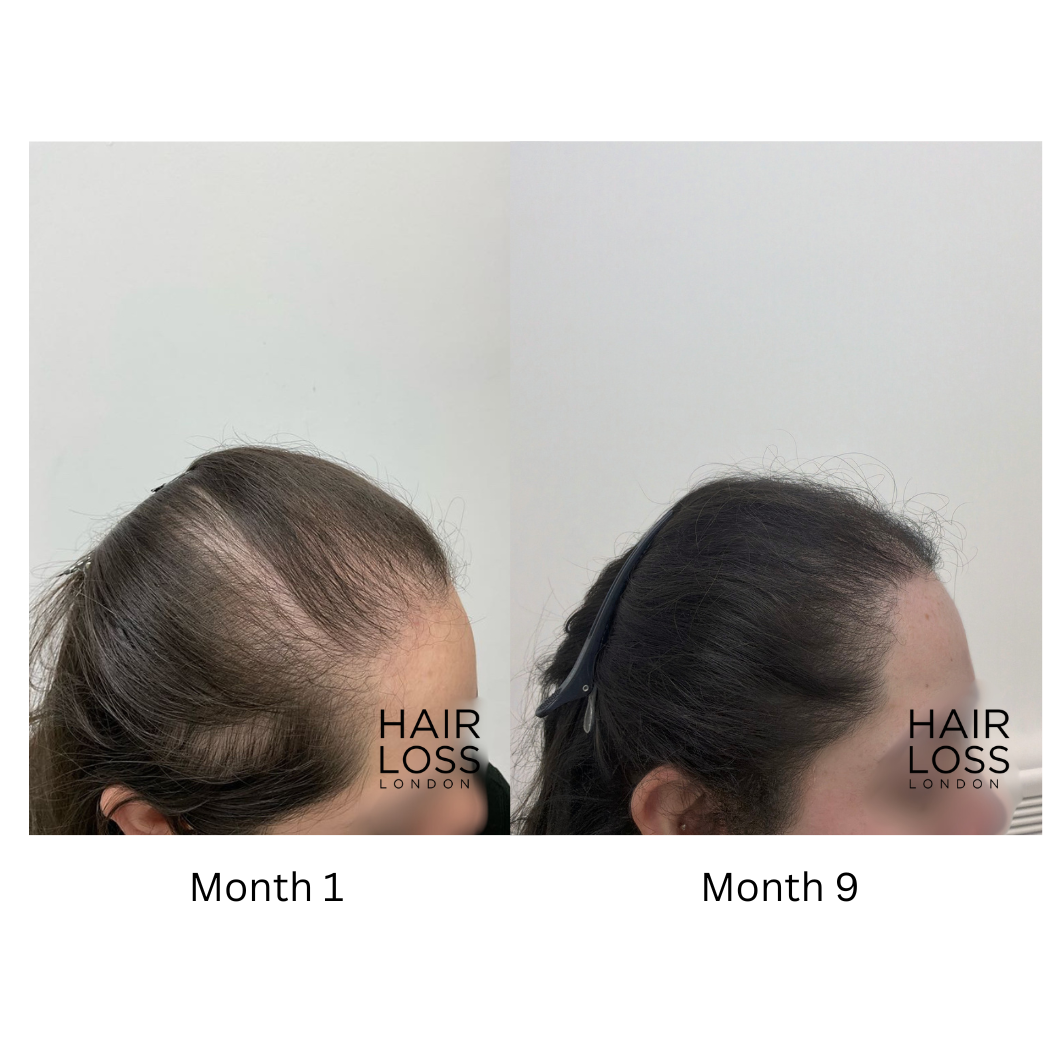 Hair loss clinic London