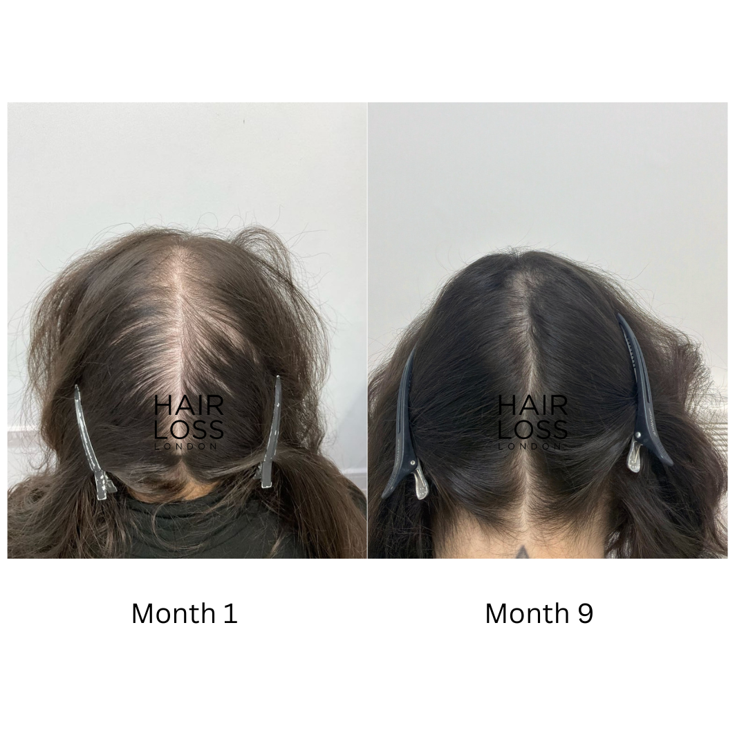 Androgenetic alopecia female