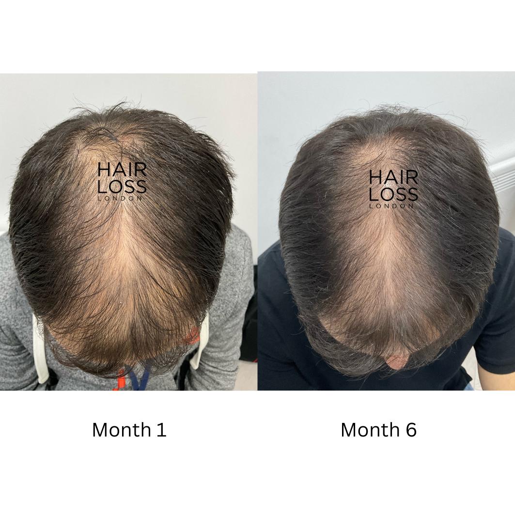 best hair loss clinic in London
