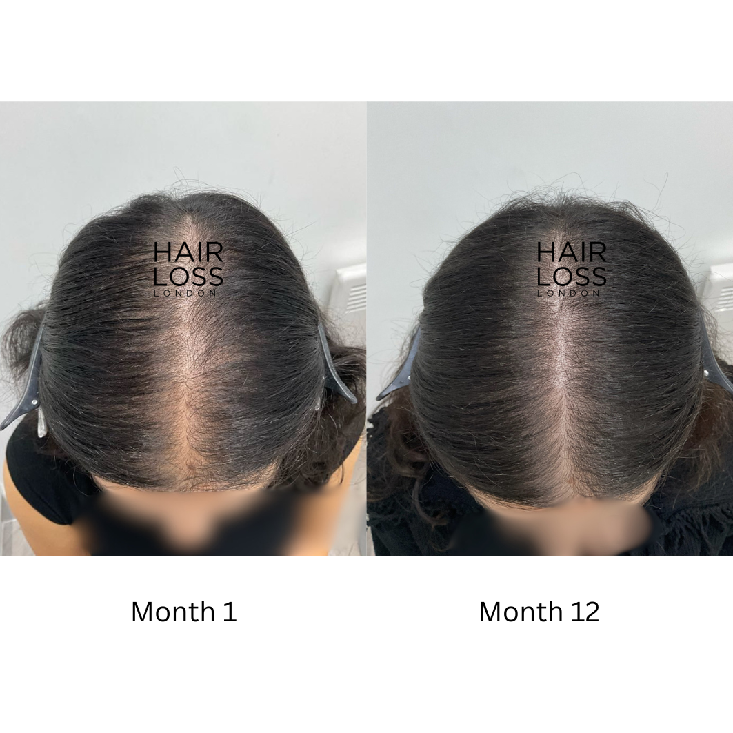 Female hair loss specialist London