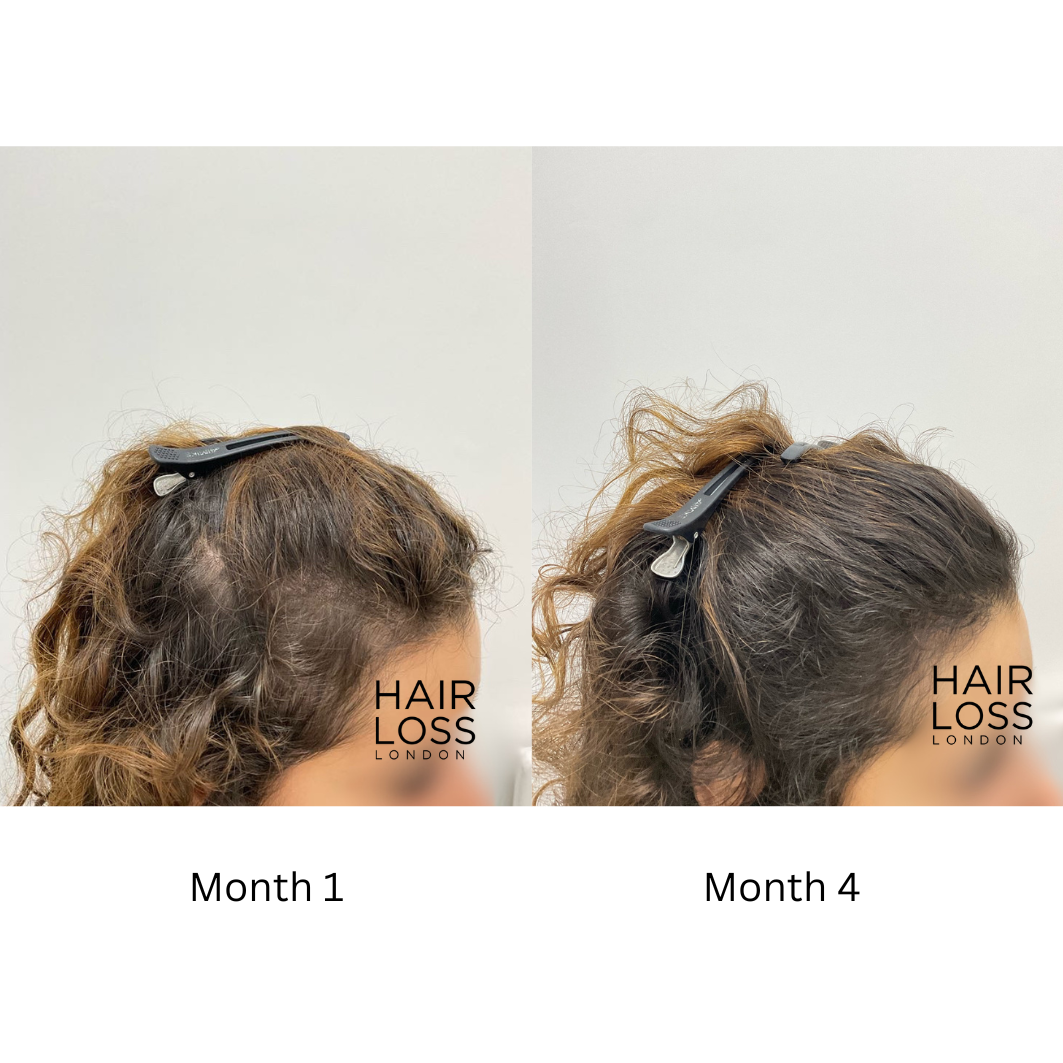 Female hair loss specialist London