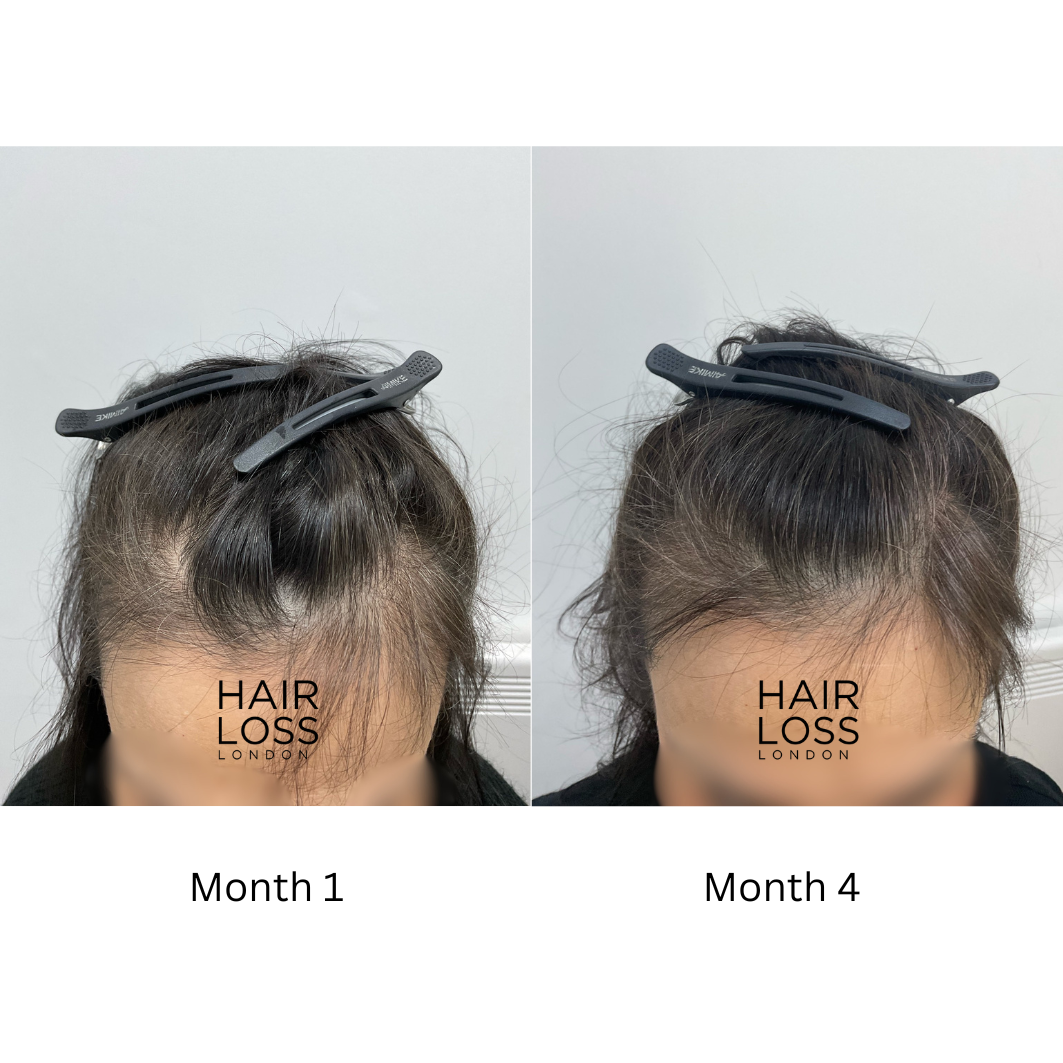 Best hair clinics london cost