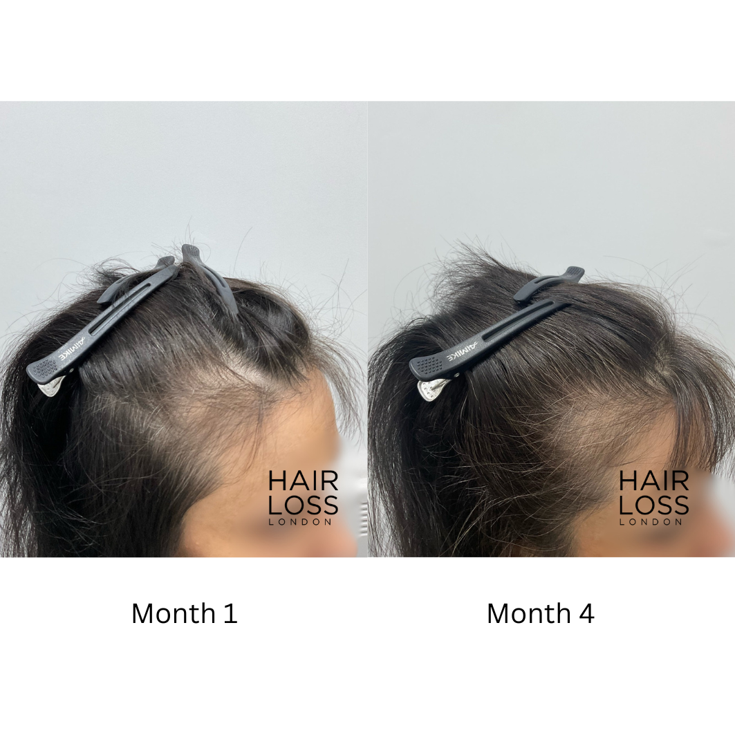 Best female hair loss Clinic London