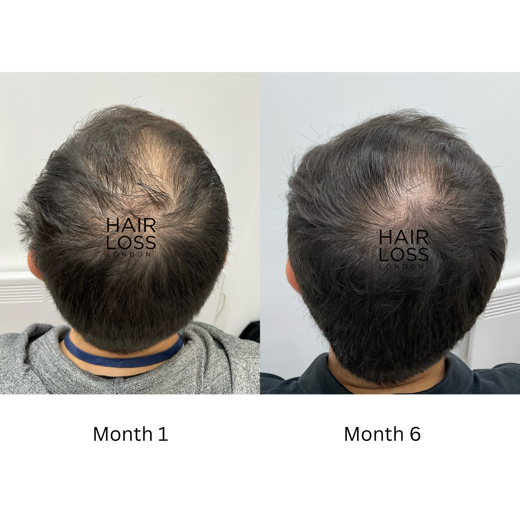 best hair clinic in london reviews