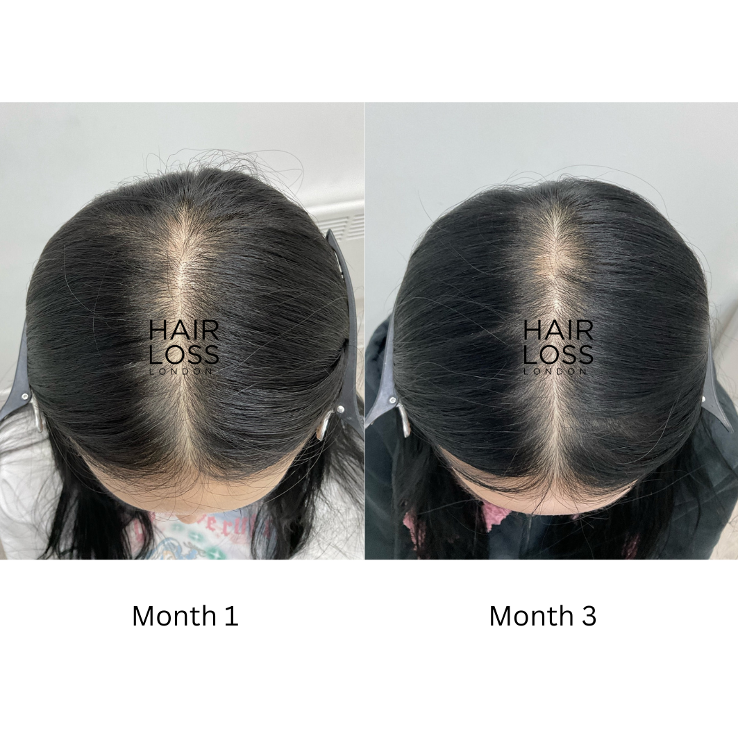 Best female hair loss Clinic London