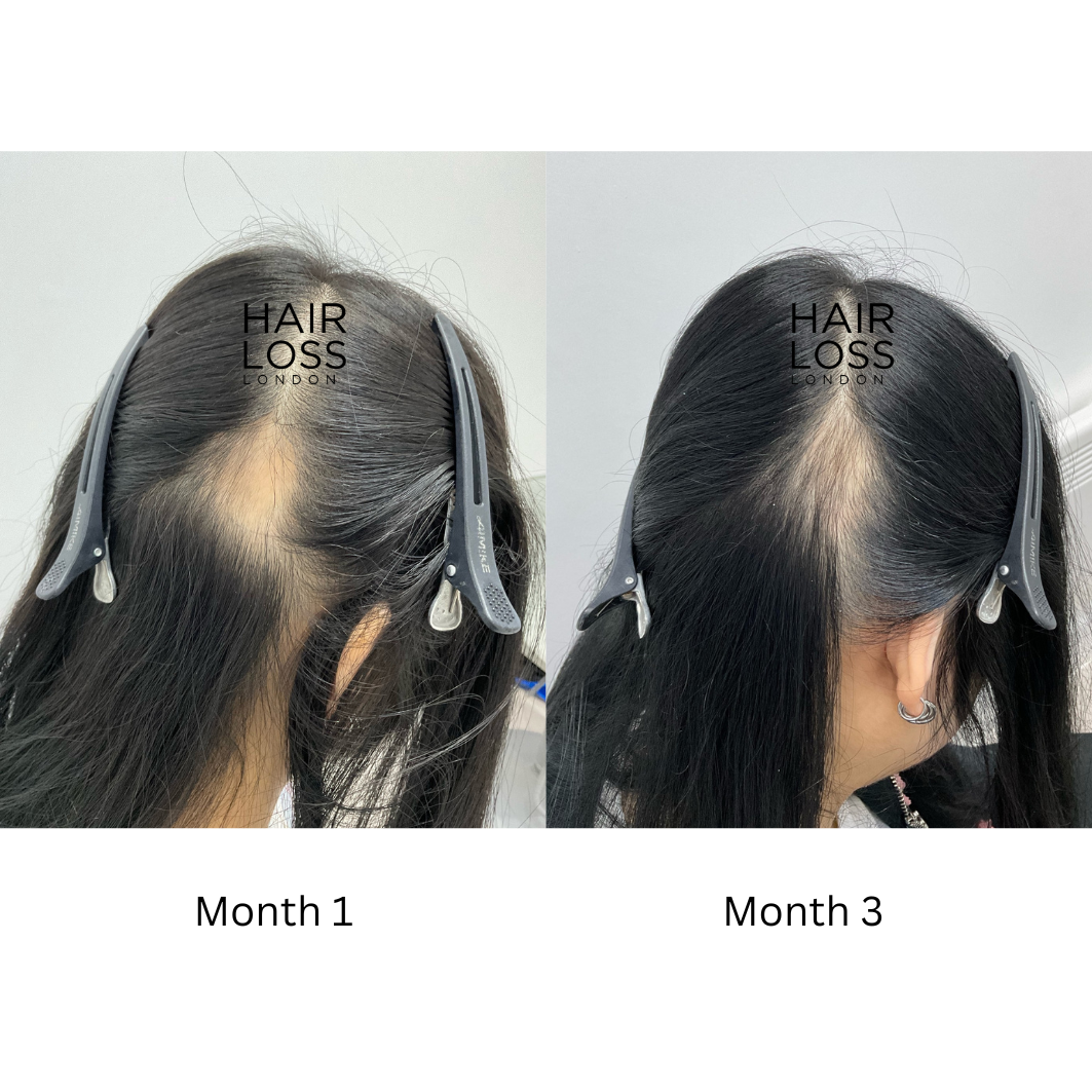alopecia hair loss