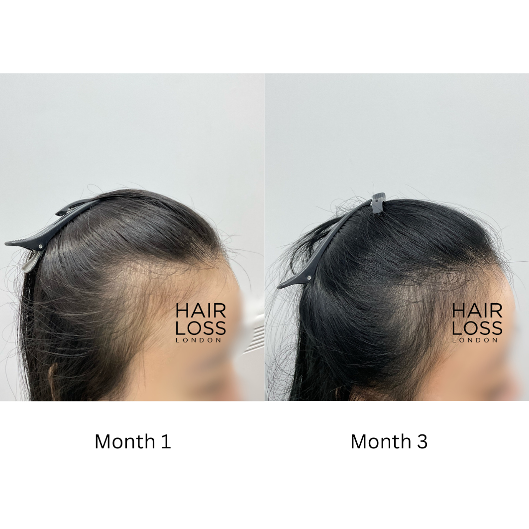 Best hair clinics london for women
